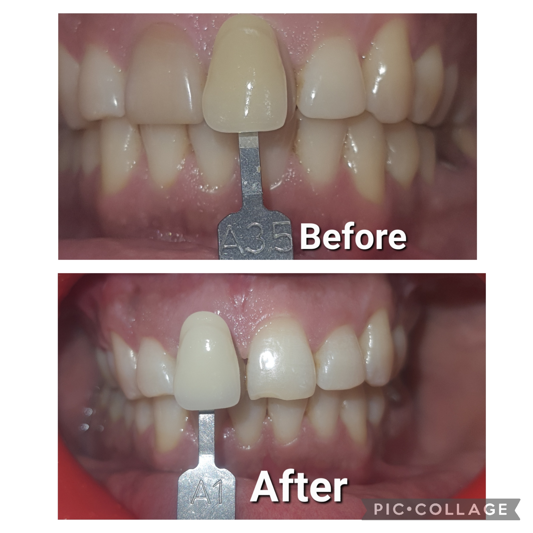 Teeth whitening/ Bleaching in greater noida